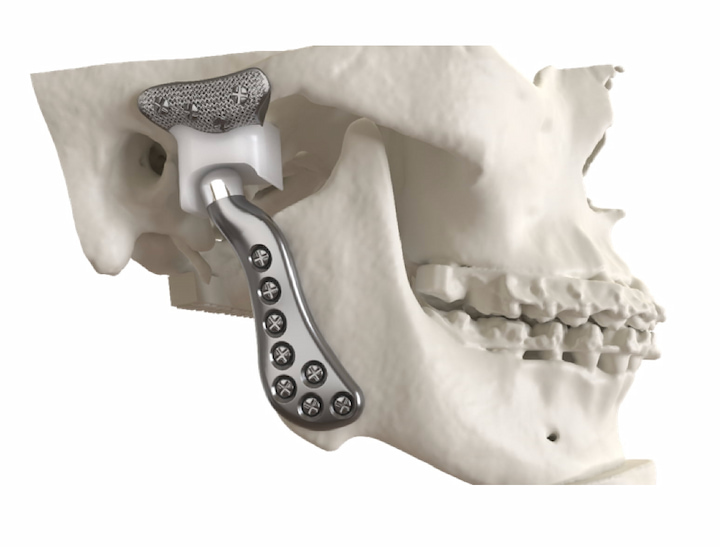 Chas' Jaw Surgery1