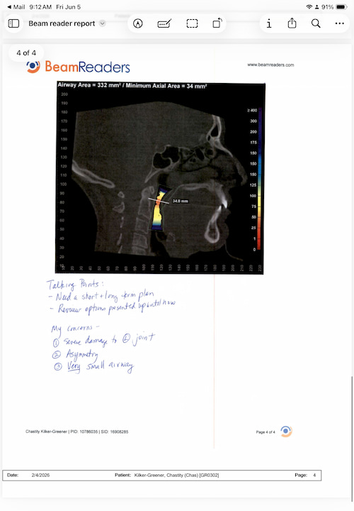 Chas airway